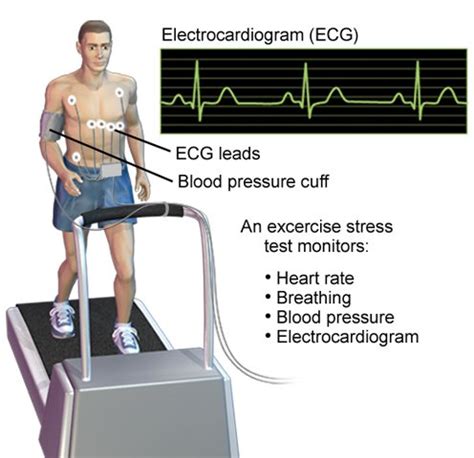 blood pressure drop during treadmill stress test|can stress test cause blood pressure.